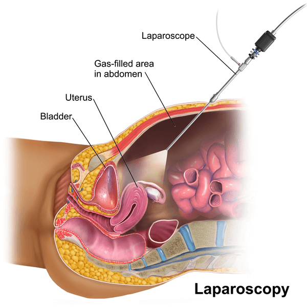 Laparoscopy diagram
